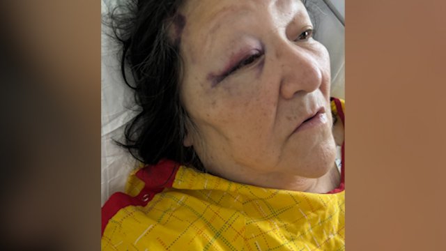Victim of fiery Aurora crash recovering in hospital, hopes safety changes are made