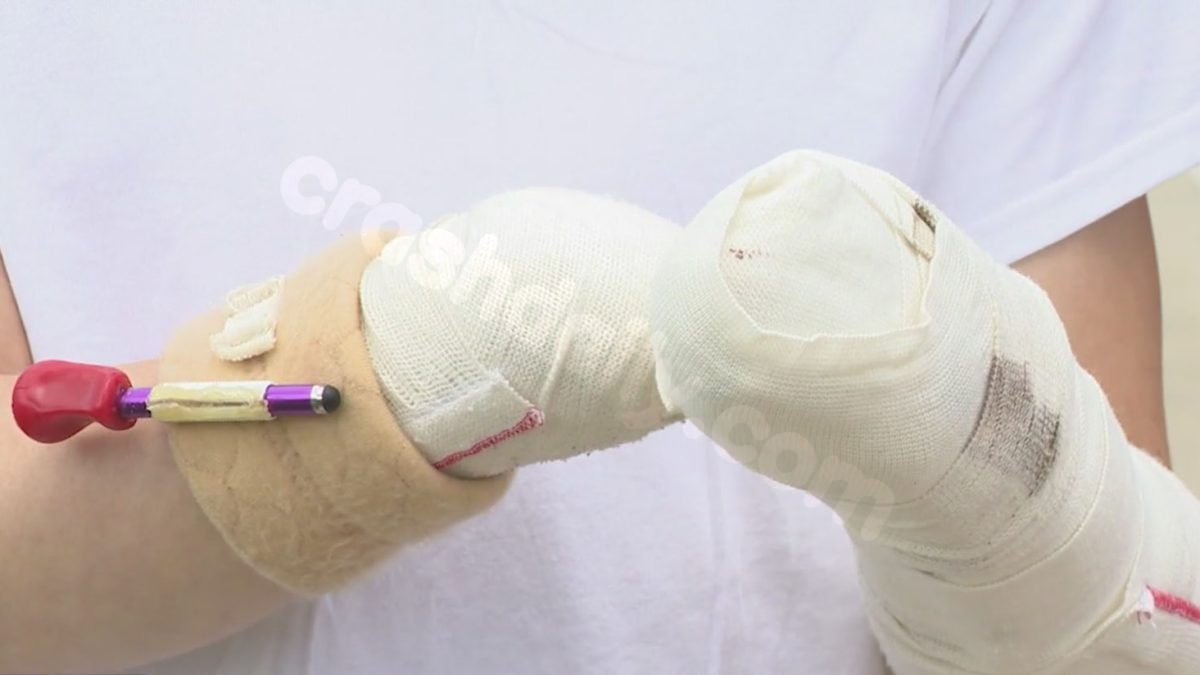 “All I saw was white, and I couldn’t hear” Teen loses hand, several fingers in fireworks accident