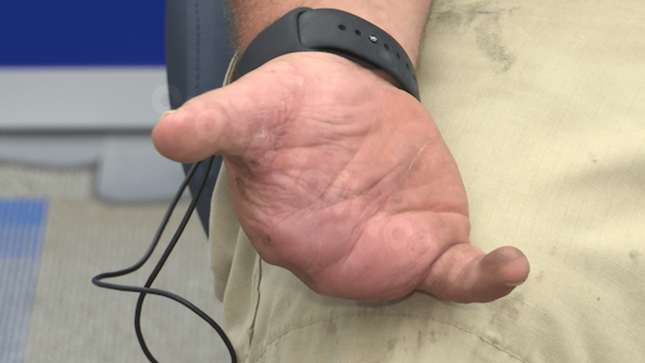 Local father who lost fingers in fireworks accident shares warning ahead of Fourth of July